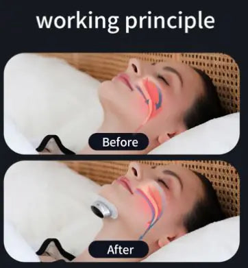 HushPulse EMS Anti-Snoring Device